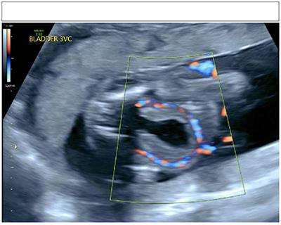 Case Report: Novel Copy Number Variant 16p11.2 Duplication Associated With Prune Belly Syndrome